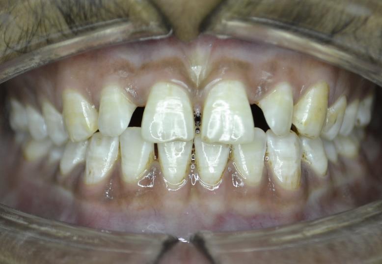 Smile before orthodontic treatment at RJ Luxe Dental, Memnagar — Before
