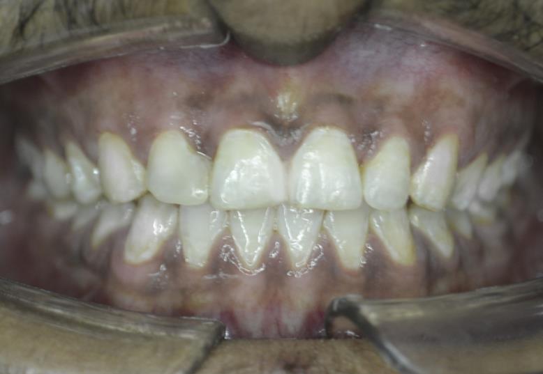Smile transformation after orthodontic treatment at RJ Luxe Dental, Ahmedabad — After