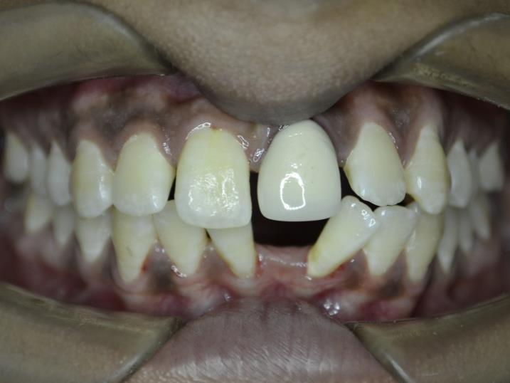 Smile before cosmetic dentistry treatment at RJ Luxe Dental — Before