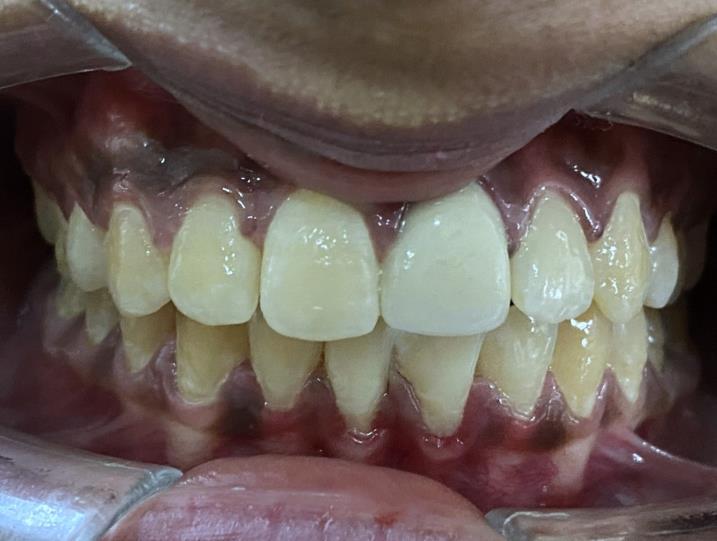 Cosmetic dentistry smile makeover result at RJ Luxe Dental, Ahmedabad — After