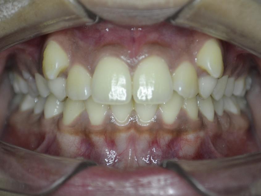 Missing teeth before dental implant treatment at RJ Luxe Dental — Before