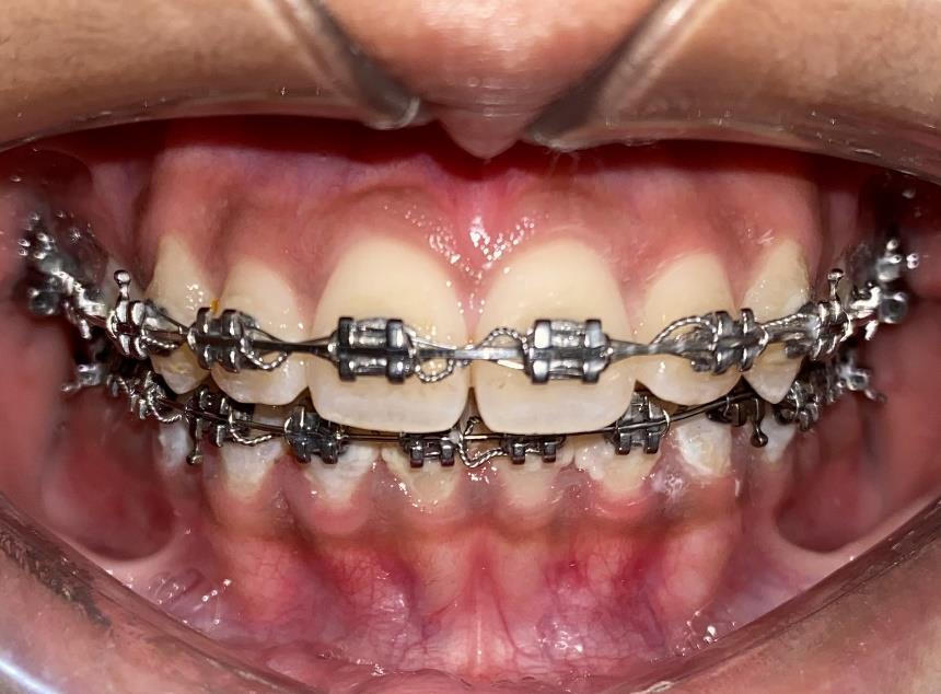 Dental implants and smile restoration result at RJ Luxe Dental, Ahmedabad — After